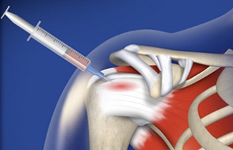 PRP injection in shoulder