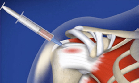 prp injection shoulder